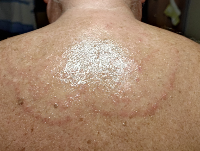 Hautrötung, Bläschen, Juckreiz