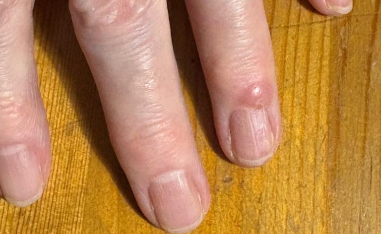 Zyste Ringfinger